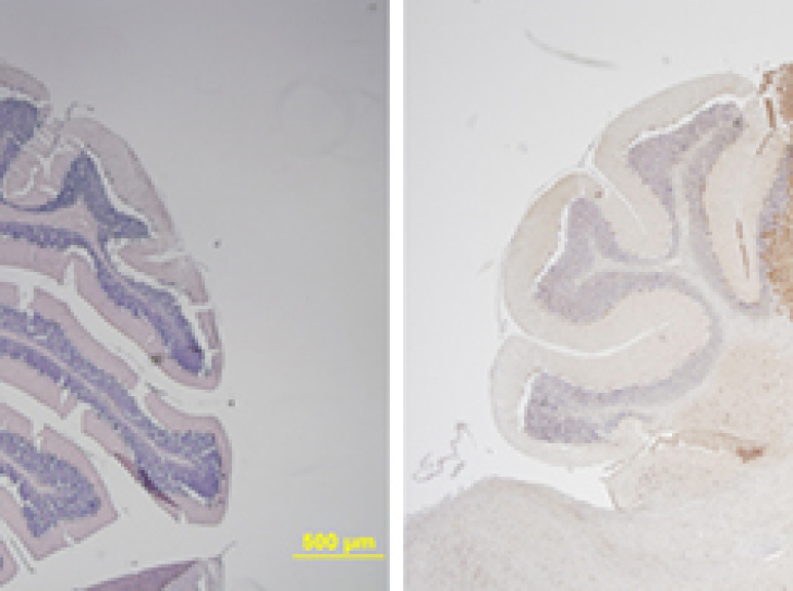In the eye of the medulloblastoma