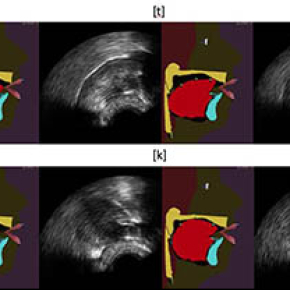 Augmented tongue ultrasound for speech therapy